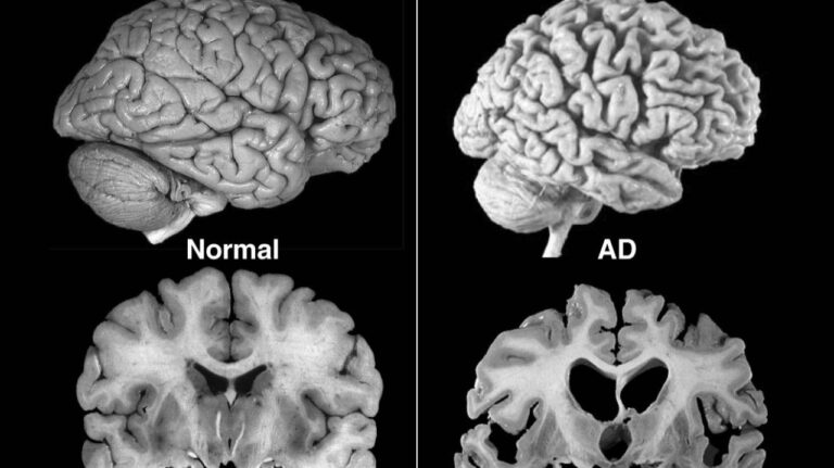Alzheimer's Brain Scan