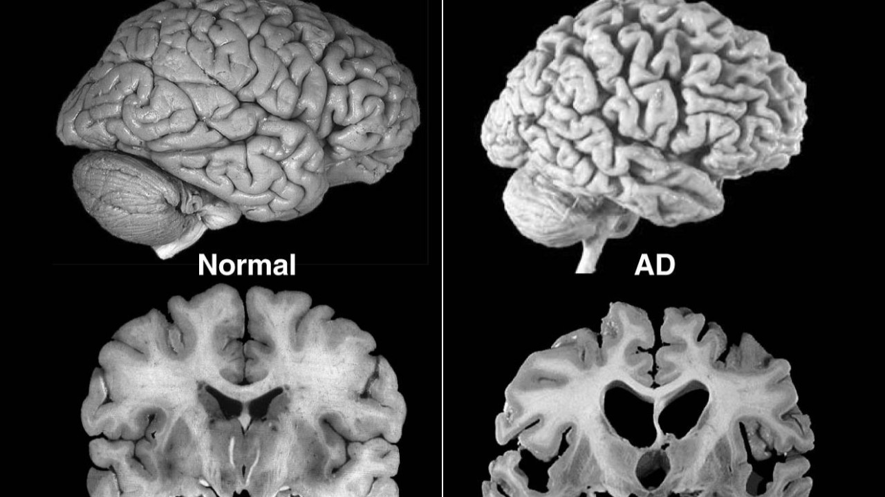 Alzheimer's Brain Scan